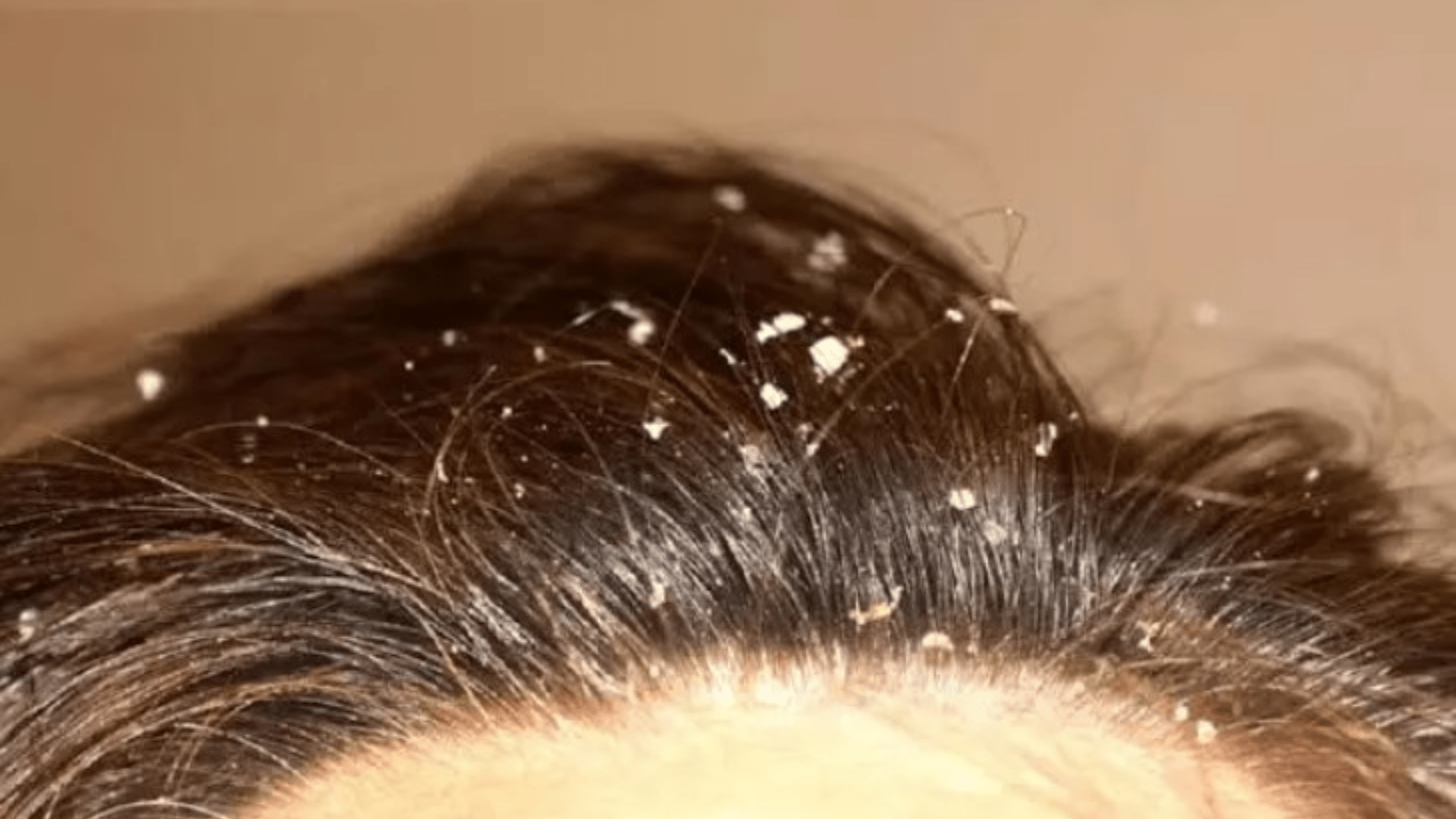 Dandruff Problem: Headache due to dandruff? So follow these tips!