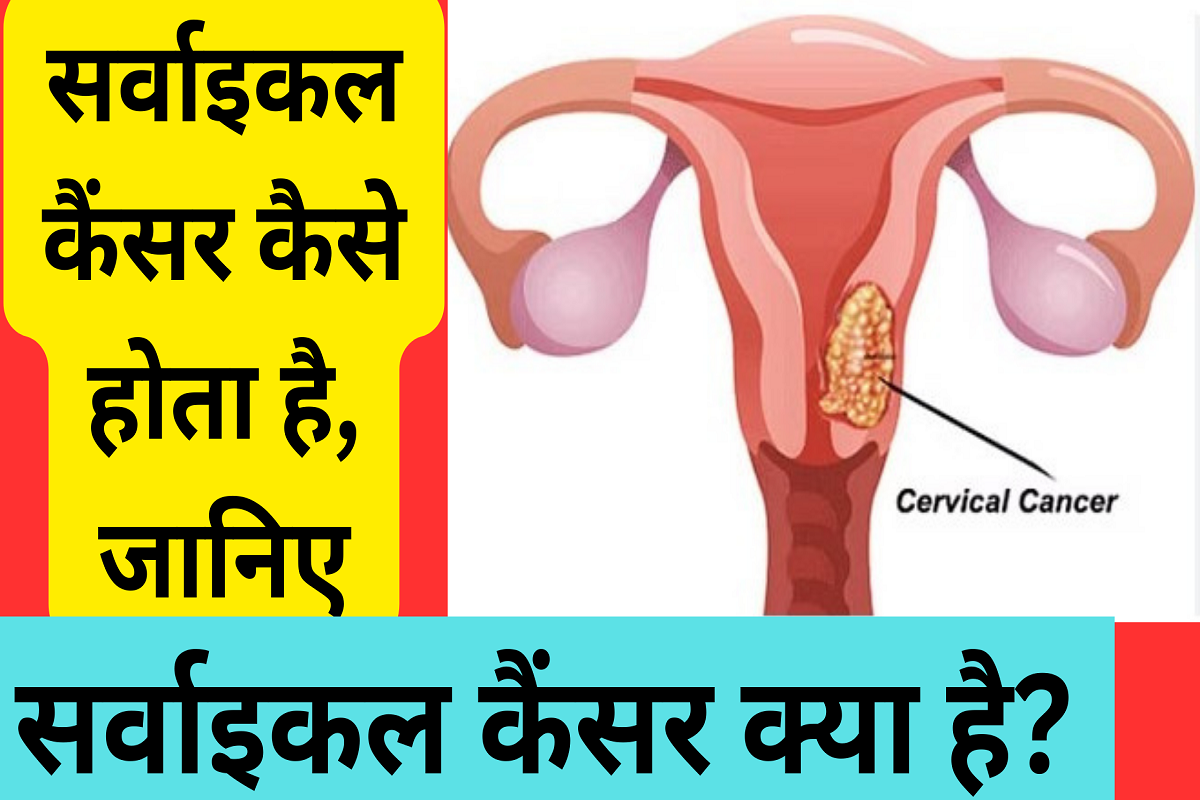 Cervical Cancer: What is Cervical Cancer? Know how cervical cancer occurs